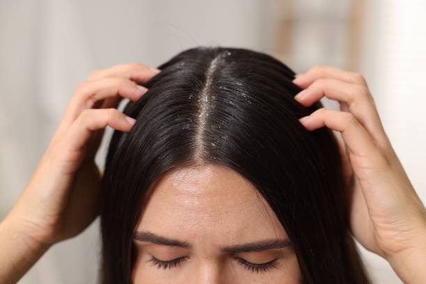 Anti Dandruff